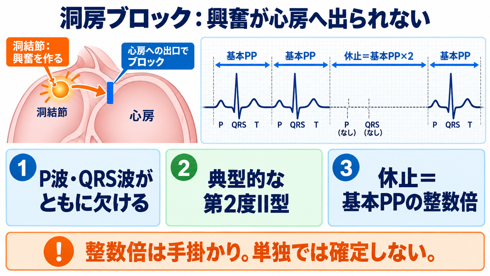心電図でP波・QRS波が予定位置にないときの見分け方―洞停止、洞房ブロック、房室ブロック、ブロックSVPC：洞房ブロックでは洞結節が作った興奮が心房へ出られず、P波とQRS波がともに抜けるの図解