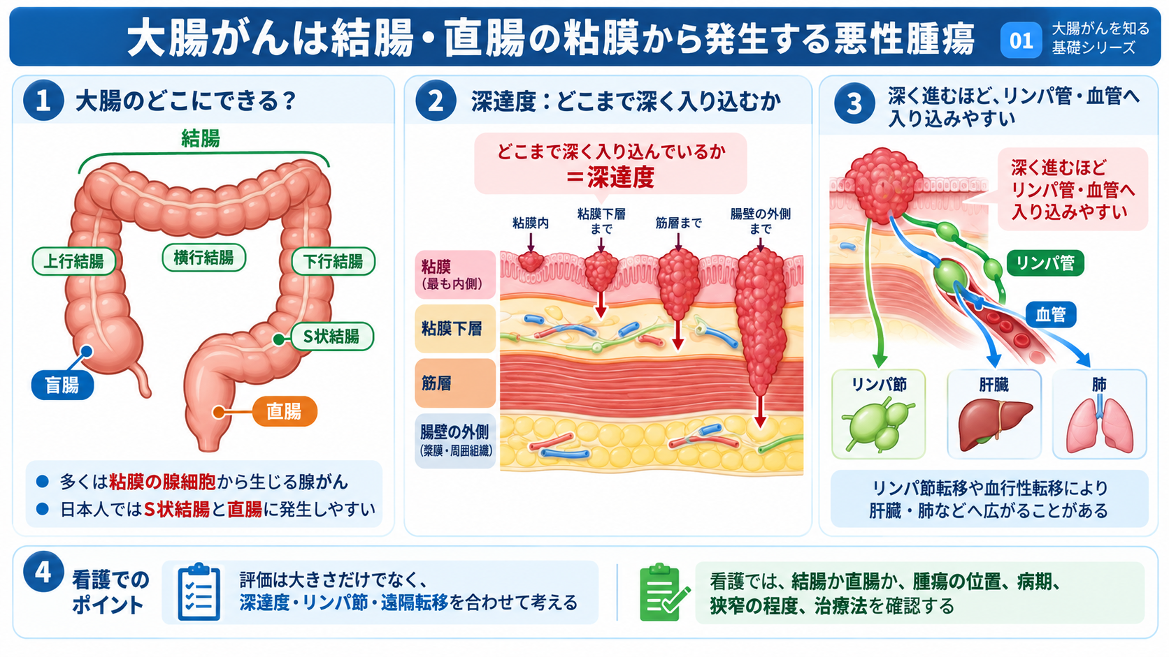 大腸がんとは？症状・検査・治療から術後の看護観察まで分かりやすく解説：大腸がんは結腸・直腸の粘膜から発生する悪性腫瘍の図解
