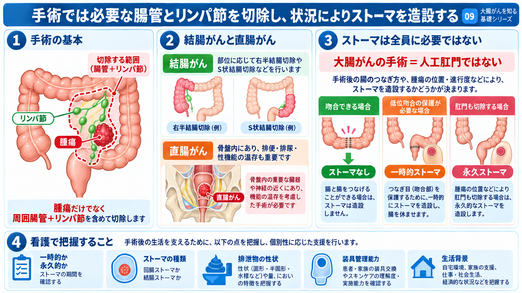 大腸がんとは？症状・検査・治療から術後の看護観察まで分かりやすく解説：手術では腫瘍だけでなく必要な腸管とリンパ節を切除し、状況によってストーマを造設するの図解
