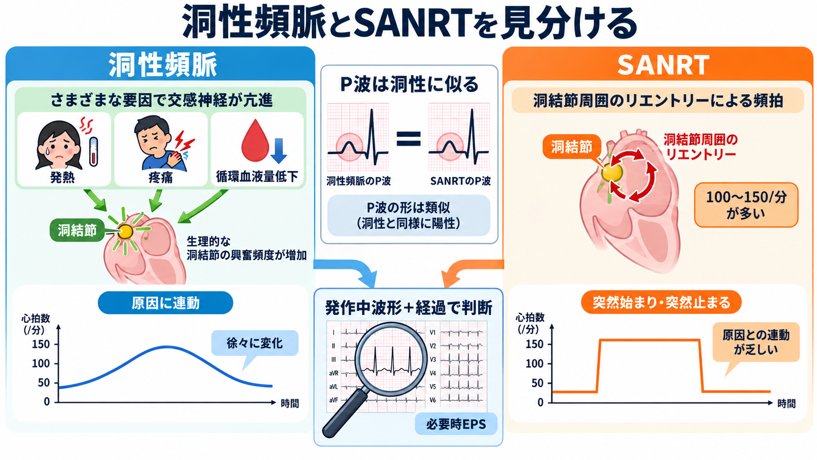 頻脈の見分け方：洞性頻脈・PSVT・AVNRT・AVRT・SANRT・AT・2:1心房粗動を順番に理解する：洞性頻脈とSANRTのP波は似るが、「原因との連動」と「開始・停止」が違うの図解