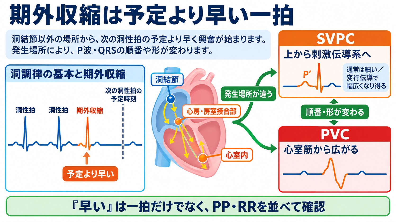 予定よりP波・QRS波が早いときの読み方――PVC、間入性・代償性休止期、副収縮、SVPCの見分け方と分類：「期外収縮」は、次に来るはずの洞性興奮より先に出る一拍の図解