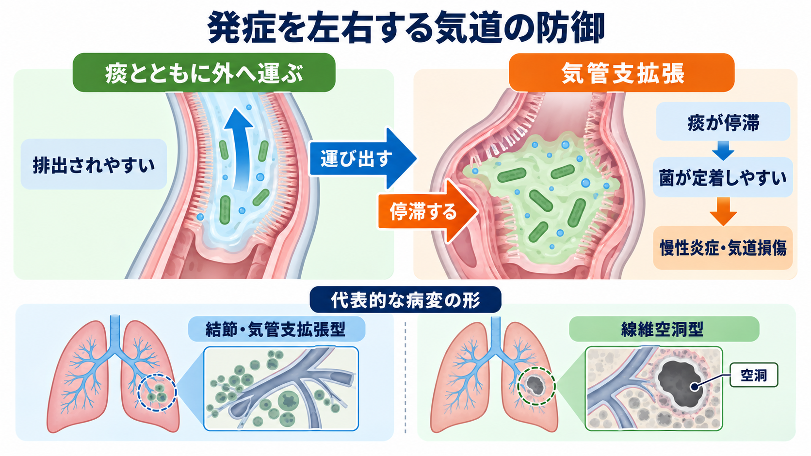 肺NTM症とは？診断・治療と看護観察を「菌が出た」から順に理解する：菌を吸い込んでも発症する人としない人がいるのは、気道の防御機能と病変の形が異なるための図解