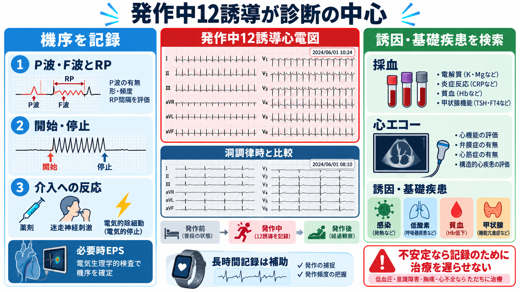 頻脈の見分け方：洞性頻脈・PSVT・AVNRT・AVRT・SANRT・AT・2:1心房粗動を順番に理解する：発作中12誘導心電図が最も重要で、検査は「機序の記録」と「誘因・基礎疾患の検索」に分けるの図解