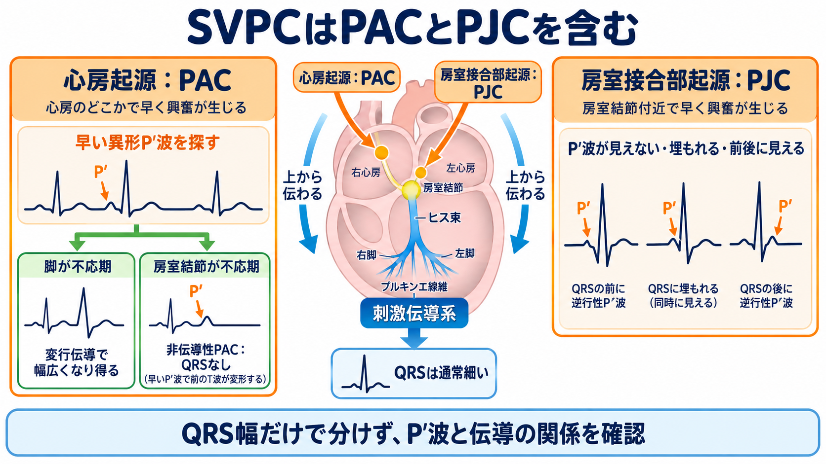 予定よりP波・QRS波が早いときの読み方――PVC、間入性・代償性休止期、副収縮、SVPCの見分け方と分類：SVPCは心房性PACと房室接合部性PJCを含み、QRSは通常細いの図解