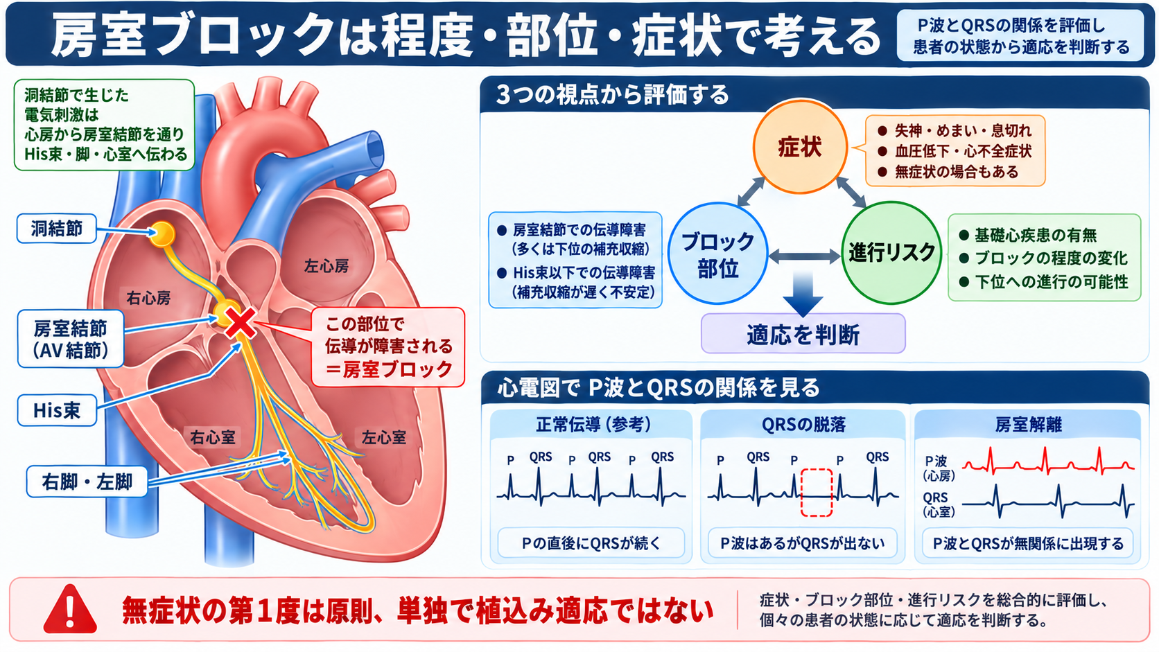 ペースメーカーの種類と適応を整理する｜VVI・DDD・リードレスから看護観察まで：房室ブロックではブロックの程度・部位・症状によって適応が変わるの図解