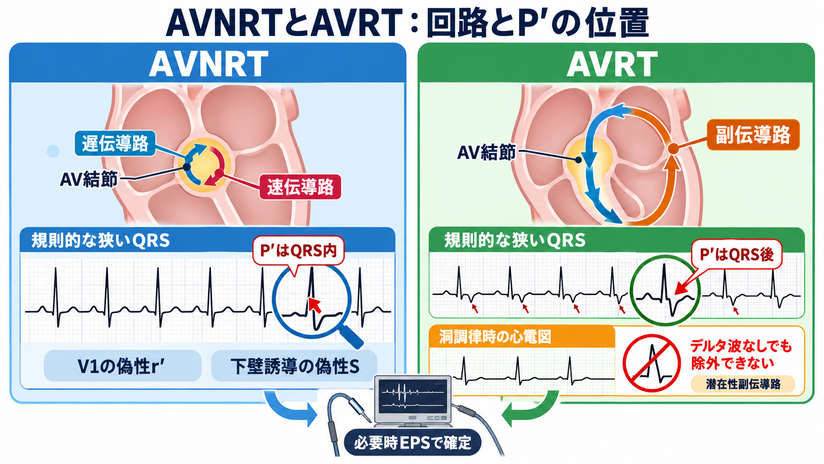 頻脈の見分け方：洞性頻脈・PSVT・AVNRT・AVRT・SANRT・AT・2:1心房粗動を順番に理解する：AVNRTは房室結節周囲、AVRTは副伝導路まで含む回路であり、P波の位置と洞調律時心電図が手がかりになるの図解