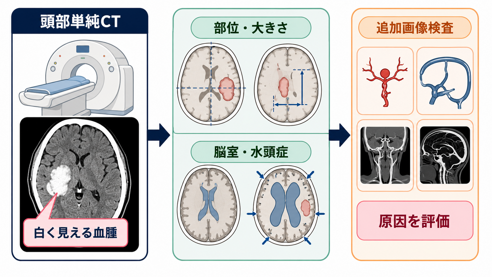 脳出血とは？部位別症状・急性期治療・看護の観察ポイントをわかりやすく解説：脳出血の症状は出血部位で傾向が変わるが、典型像だけで判断しないの図解