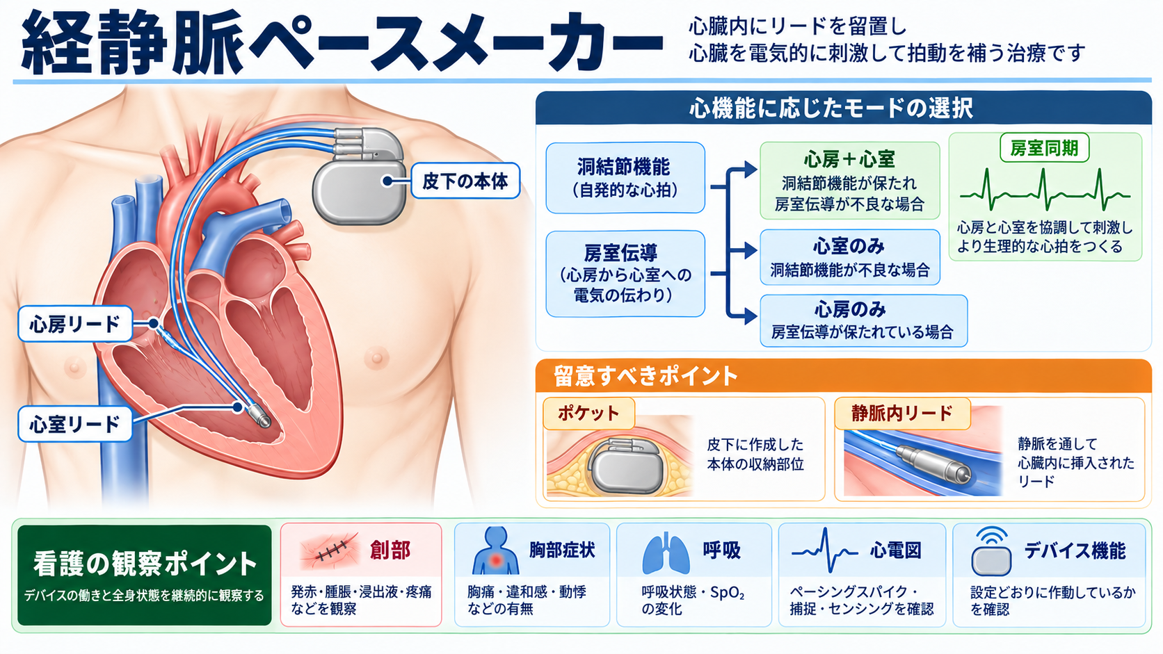 ペースメーカーの種類と適応を整理する｜VVI・DDD・リードレスから看護観察まで：経静脈ペースメーカーは心房・心室を組み合わせてペーシングできる標準的なシステムの図解