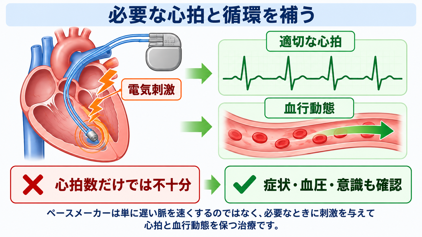 ペースメーカーの種類と適応を整理する｜VVI・DDD・リードレスから看護観察まで：ペースメーカーは「遅い脈を速くする装置」ではなく必要な心拍を電気刺激で補う治療の図解