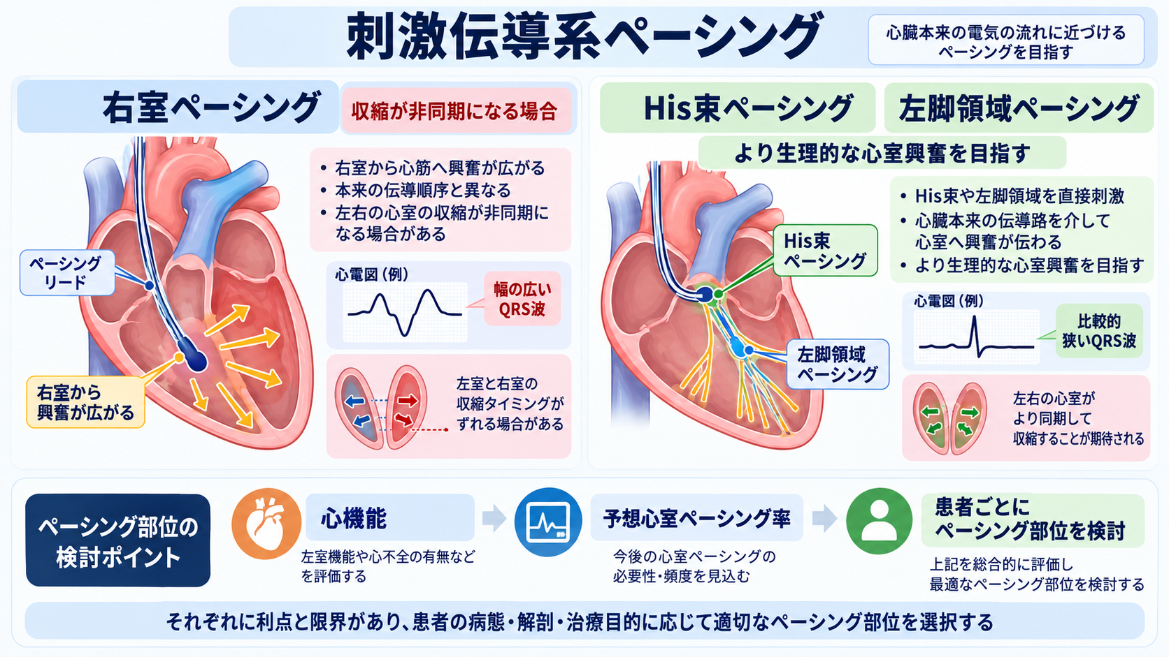 ペースメーカーの種類と適応を整理する｜VVI・DDD・リードレスから看護観察まで：刺激伝導系ペーシングはより生理的な心室興奮を目指す方法の図解