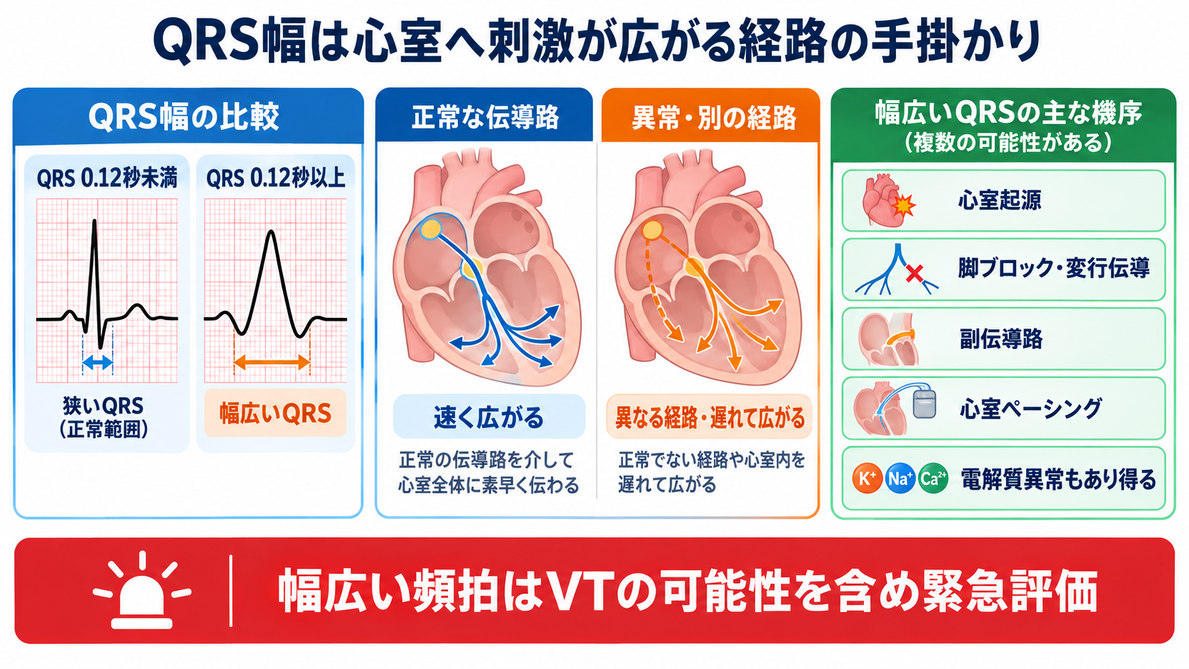 心電図の読み方を基礎から整理｜新人看護師・看護学生のための判読手順と緊急波形：QRS幅は心室へ刺激が広がる経路を考える手掛かりになるの図解