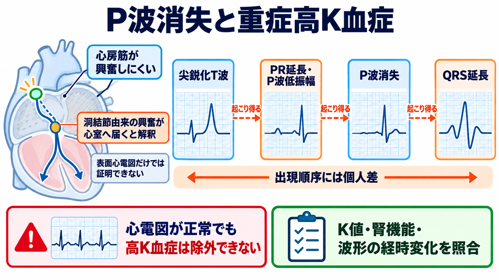 P-QRS関係で見分ける基本調律の異常―心房細動・接合部調律・固有心室調律・心房停止・洞室伝導：洞室伝導は重症高カリウム血症を示唆する、見逃せないP波消失パターンの図解