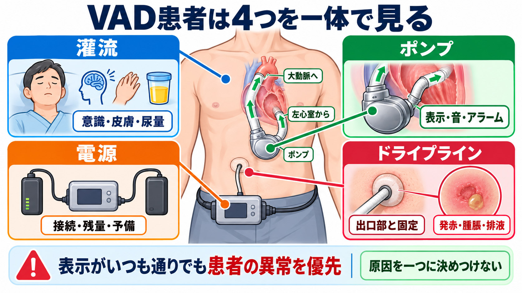 ペースメーカーとVADの違いとは？仕組み・適応・看護観察を循環の視点で整理：VAD患者では、灌流・ポンプ・電源・ドライブラインを一体で見るの図解