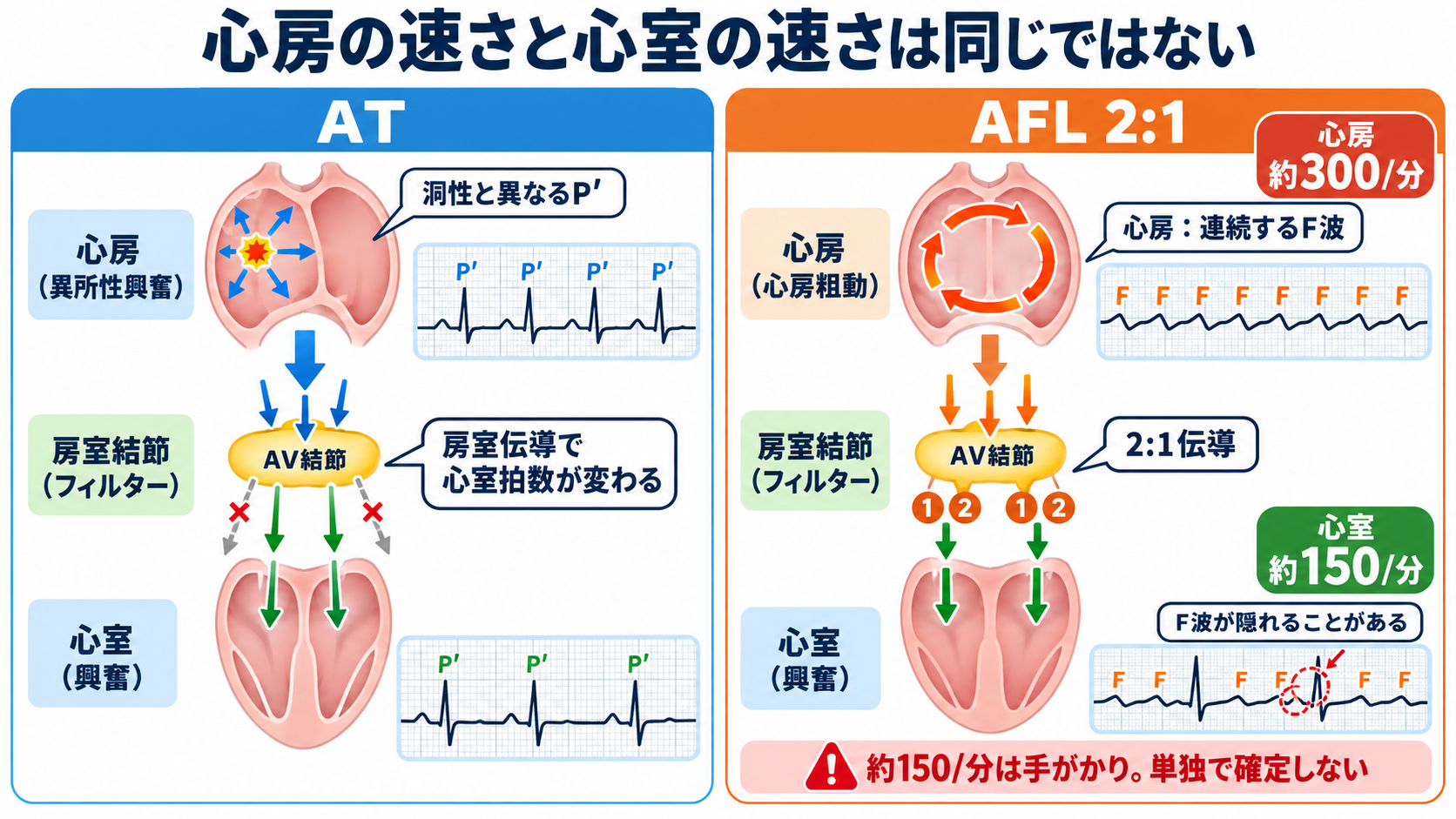 頻脈の見分け方：洞性頻脈・PSVT・AVNRT・AVRT・SANRT・AT・2:1心房粗動を順番に理解する：ATと2:1心房粗動は心房の頻拍が主体で、房室結節を通る回数が心室拍数を決めるの図解
