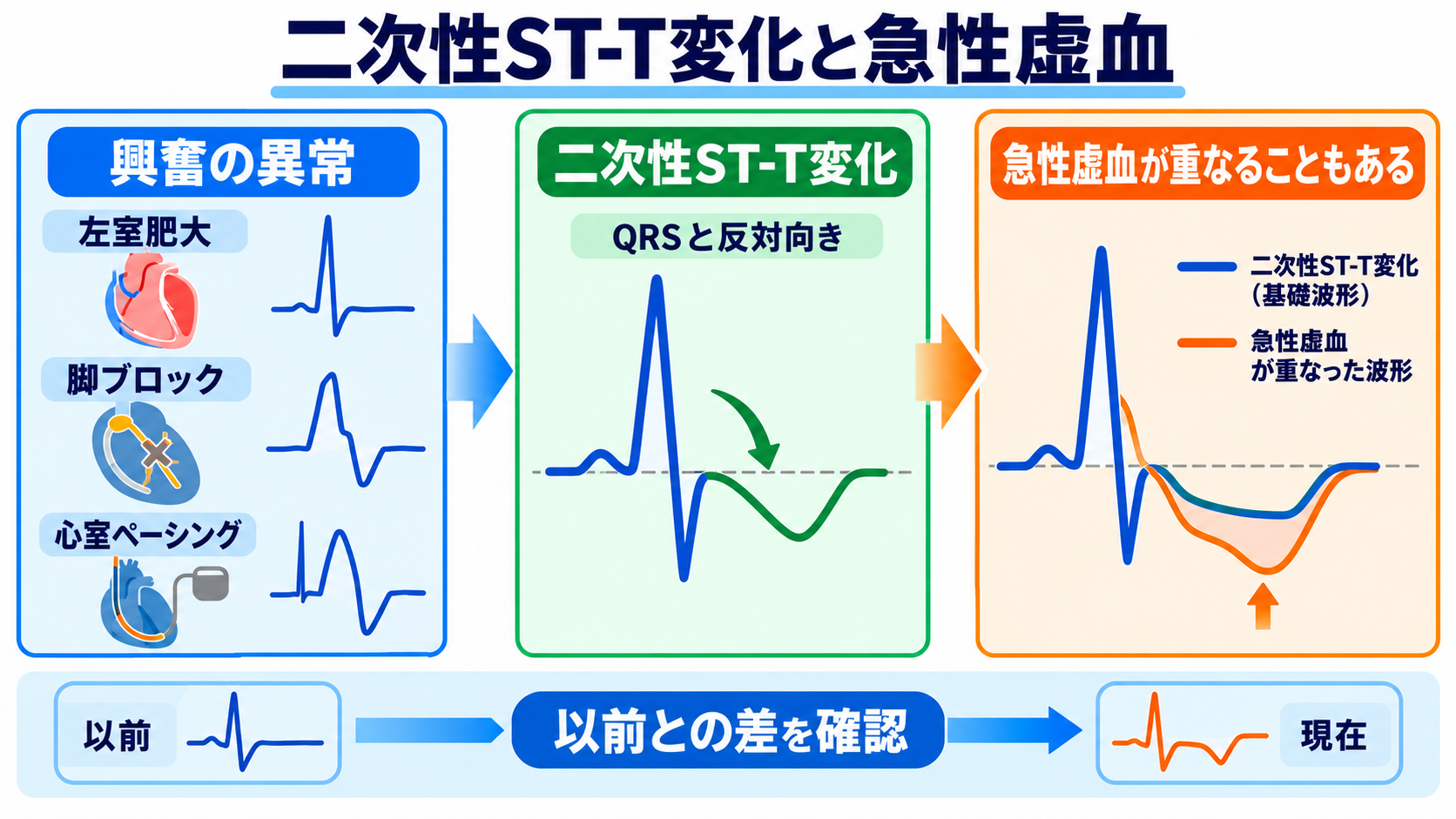 ST下降をどう読む？心筋虚血・心内膜下梗塞と二次性変化、薬剤・電解質異常の見分け方：二次性ST-T変化はQRSの異常に続いて生じるが、急性虚血を隠すことがあるの図解