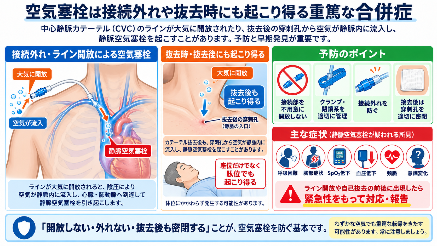 CVカテーテルとは？目的・種類から管理、観察項目、感染・閉塞・空気塞栓まで解説：空気塞栓は接続外れや抜去時にも起こり得る重篤な合併症の図解