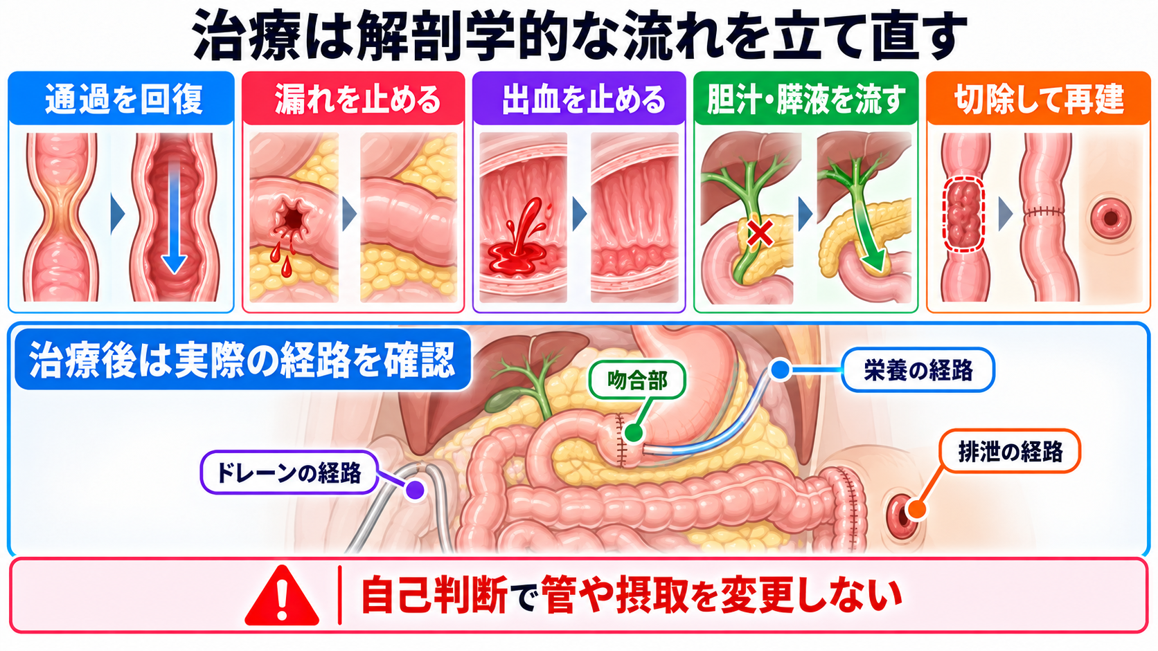 消化器の解剖を流れで理解する｜臓器・腹膜・血流と看護観察の意味：治療の目的は、通り道・漏れ・出血・流れを解剖学的に立て直すことにあるの図解