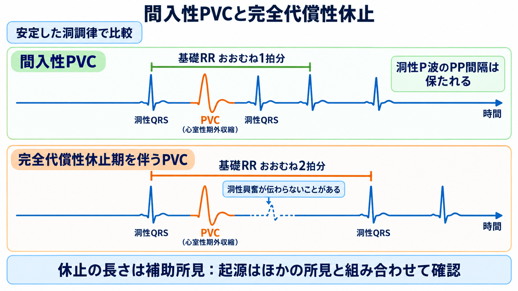 予定よりP波・QRS波が早いときの読み方――PVC、間入性・代償性休止期、副収縮、SVPCの見分け方と分類：間入性PVCは休止なし、完全代償性休止期を伴うPVCは基礎周期約2拍分の図解