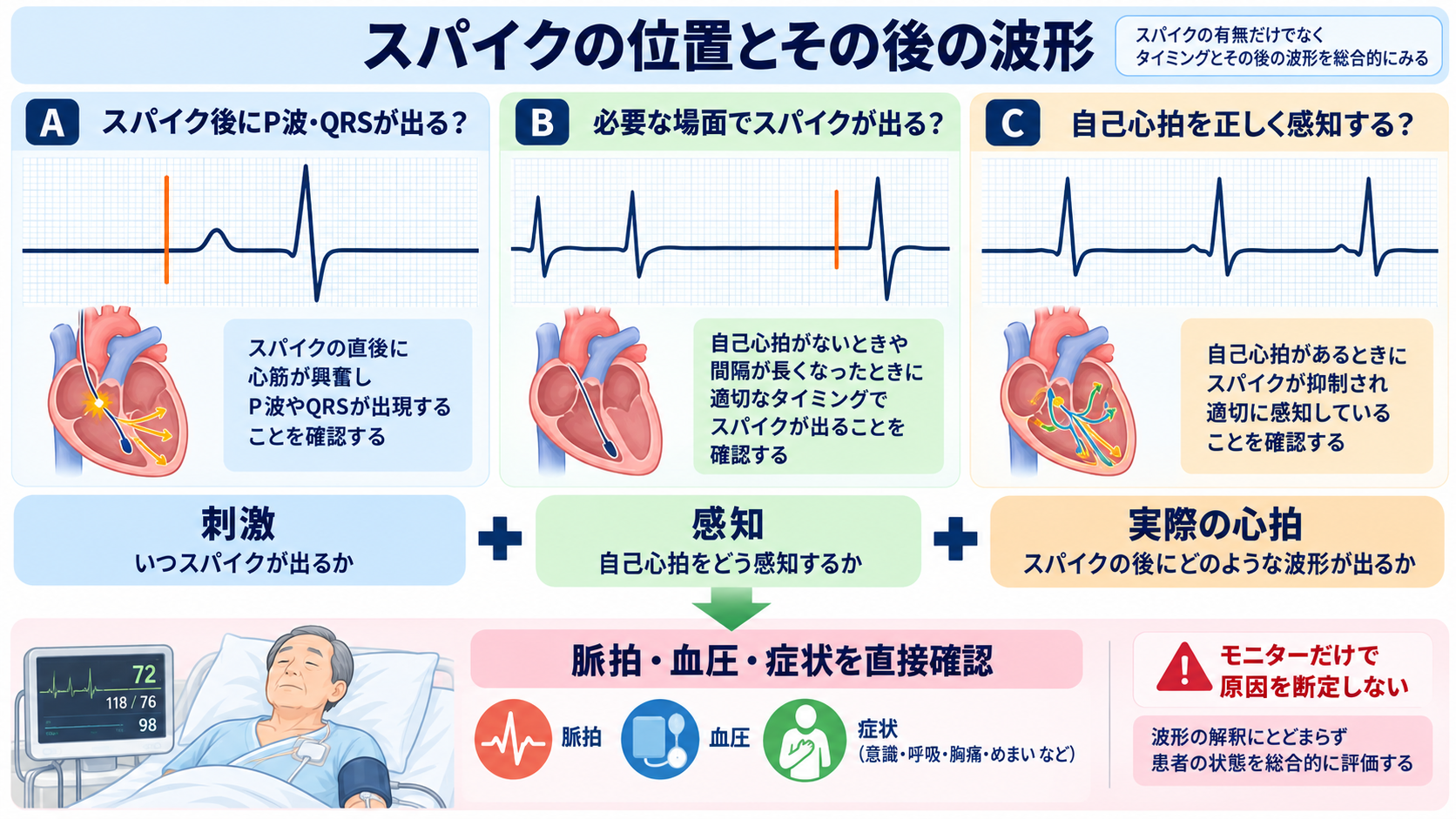 ペースメーカーの種類と適応を整理する｜VVI・DDD・リードレスから看護観察まで：ペーシング不全とセンシング不全は「スパイクの位置」とその後の波形で考えるの図解