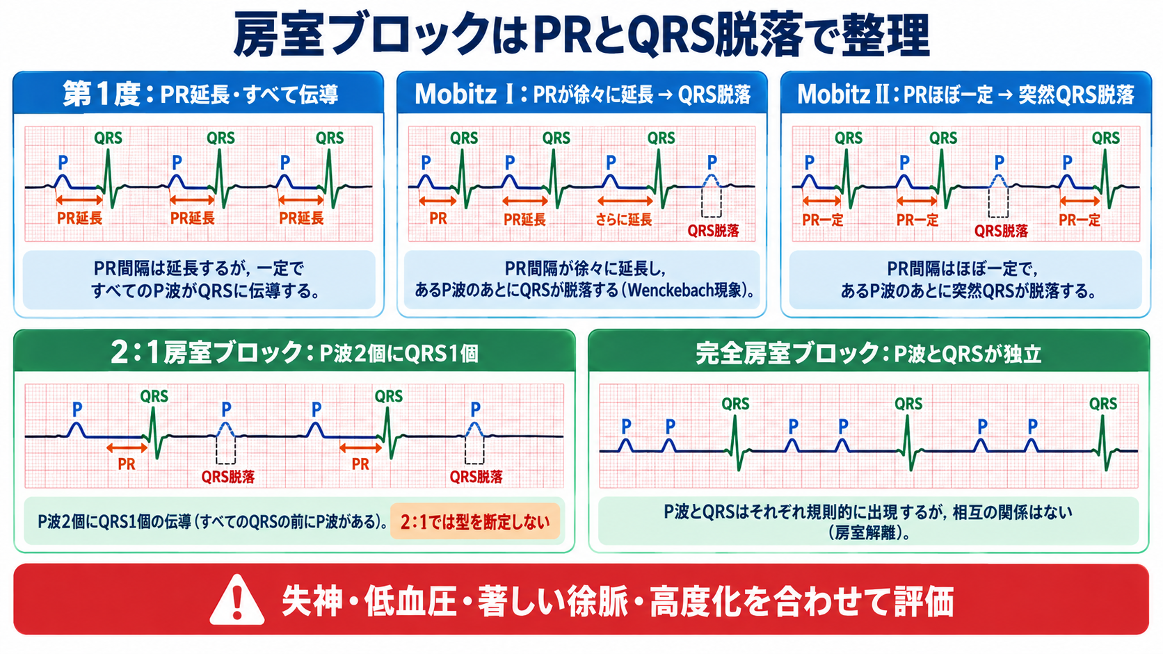 心電図の読み方を基礎から整理｜新人看護師・看護学生のための判読手順と緊急波形：房室ブロックはPR間隔とQRS脱落の仕方で整理するの図解