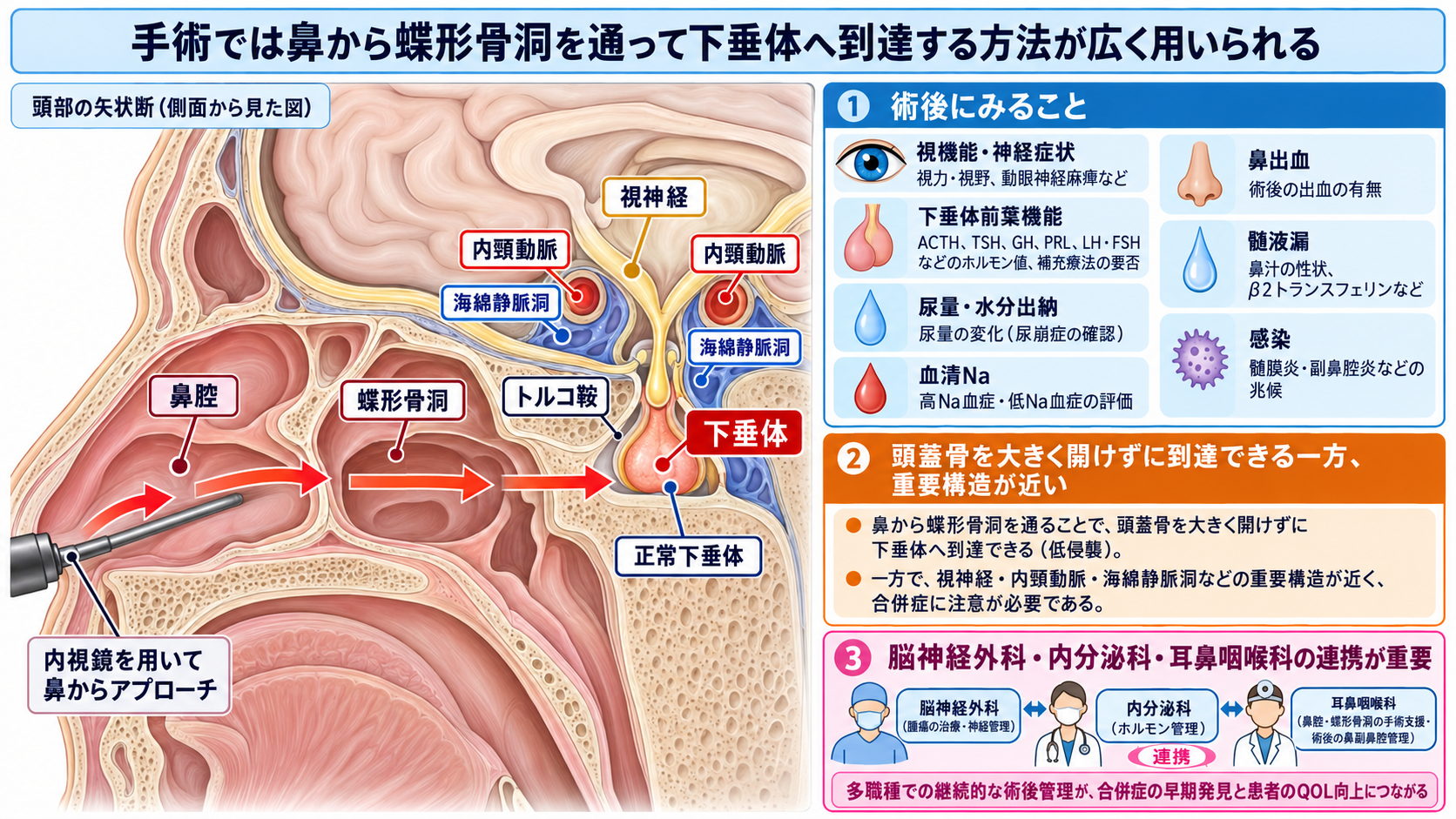 脳下垂体腫瘍とは？症状・ホルモン異常・治療と術後看護の観察ポイント：手術では鼻から蝶形骨洞を通って下垂体へ到達する方法が広く用いられるの図解