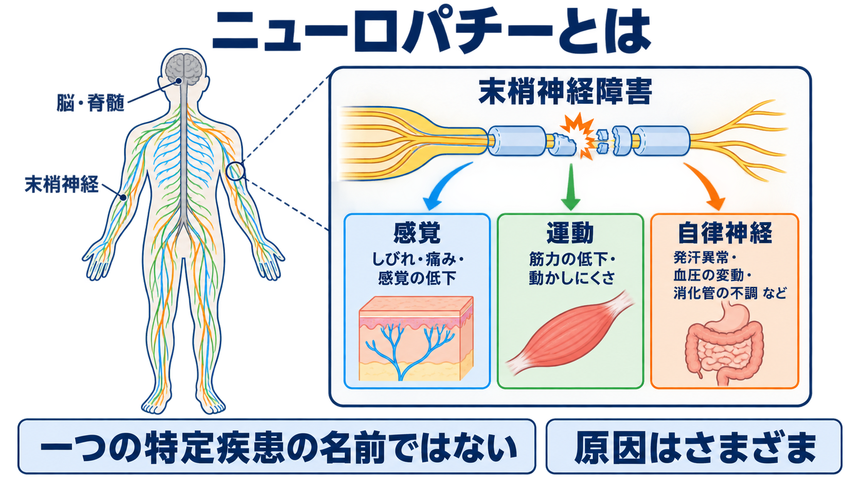 ニューロパチーとは？原因・症状・検査から看護観察と緊急性まで分かりやすく解説：ニューロパチーとは「末梢神経が障害された状態」の総称の図解