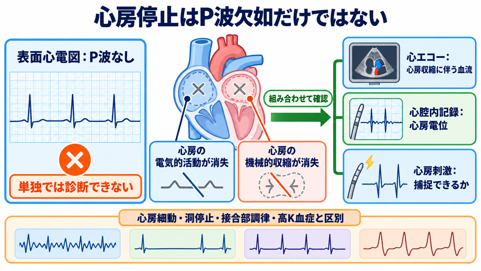 P-QRS関係で見分ける基本調律の異常―心房細動・接合部調律・固有心室調律・心房停止・洞室伝導：心房停止は「P波がない状態」ではなく、心房の電気的・機械的活動が失われた病態の図解