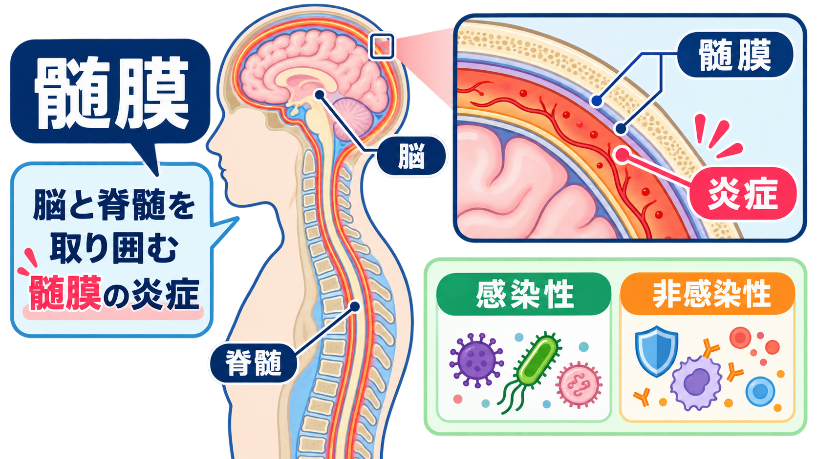髄膜炎とは？症状・髄液所見・治療の流れと看護で見るポイントをわかりやすく解説：髄膜炎は「脳と脊髄を包む髄膜に炎症が起こる病態」の図解