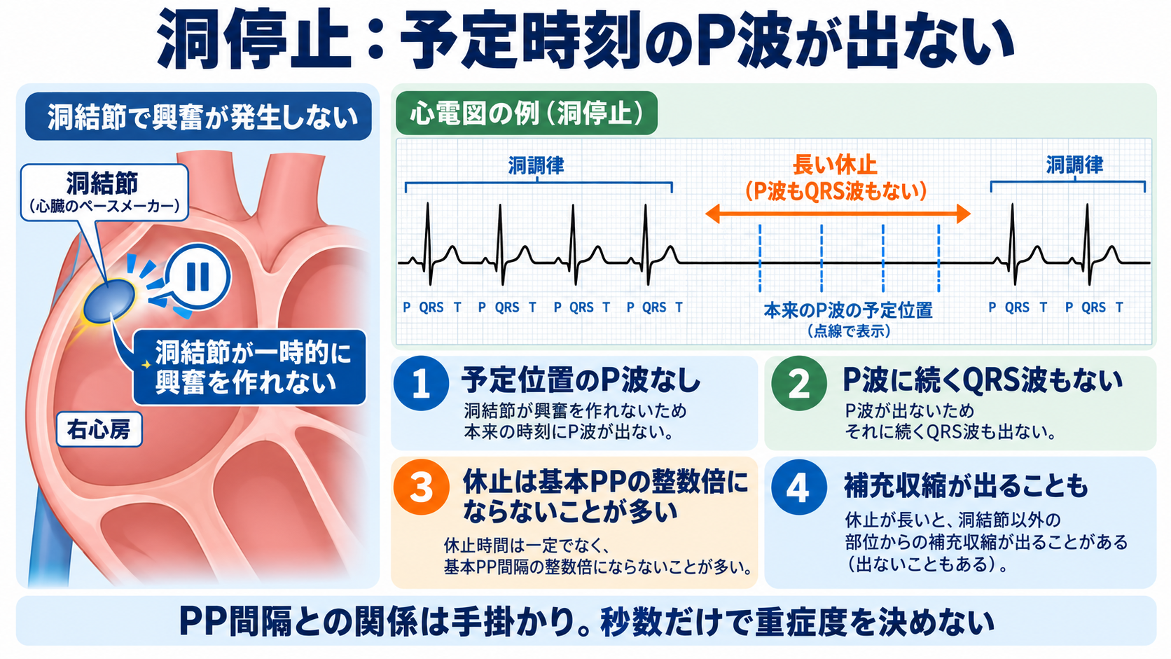 心電図でP波・QRS波が予定位置にないときの見分け方―洞停止、洞房ブロック、房室ブロック、ブロックSVPC：洞停止では予定時刻のP波が出ず、休止は基本PPの整数倍にならないことが多いの図解
