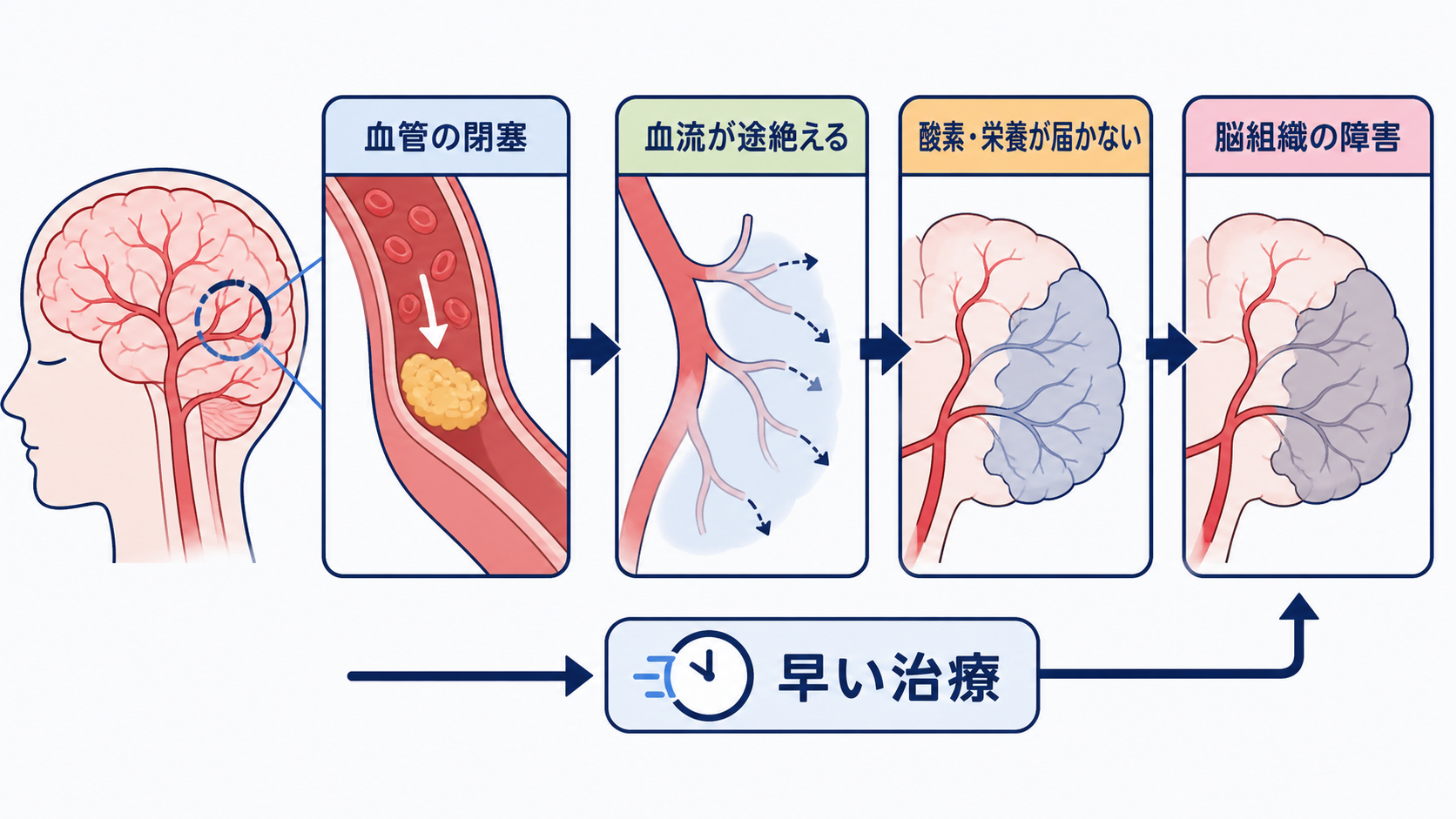 脳梗塞とは？3つの病型・症状・急性期治療・看護観察をわかりやすく解説