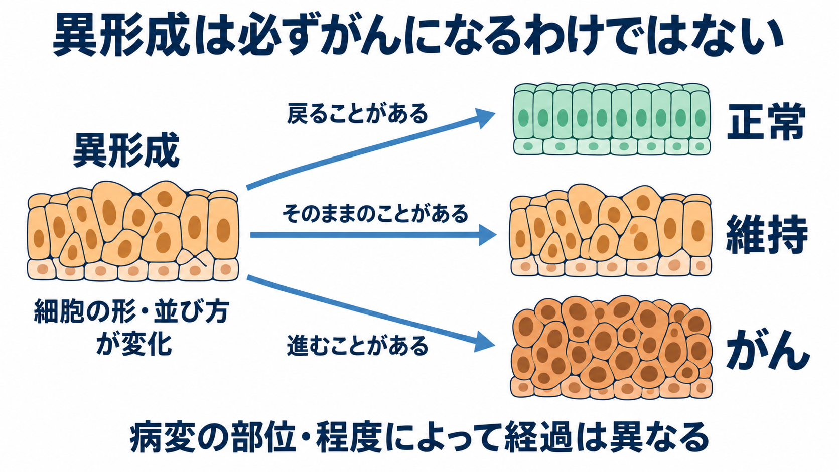 前がん病変とは？自分で気付くことの限界と、検査・看護のポイント：前がん病変は、がんへ進む可能性のある病変を指すの図解
