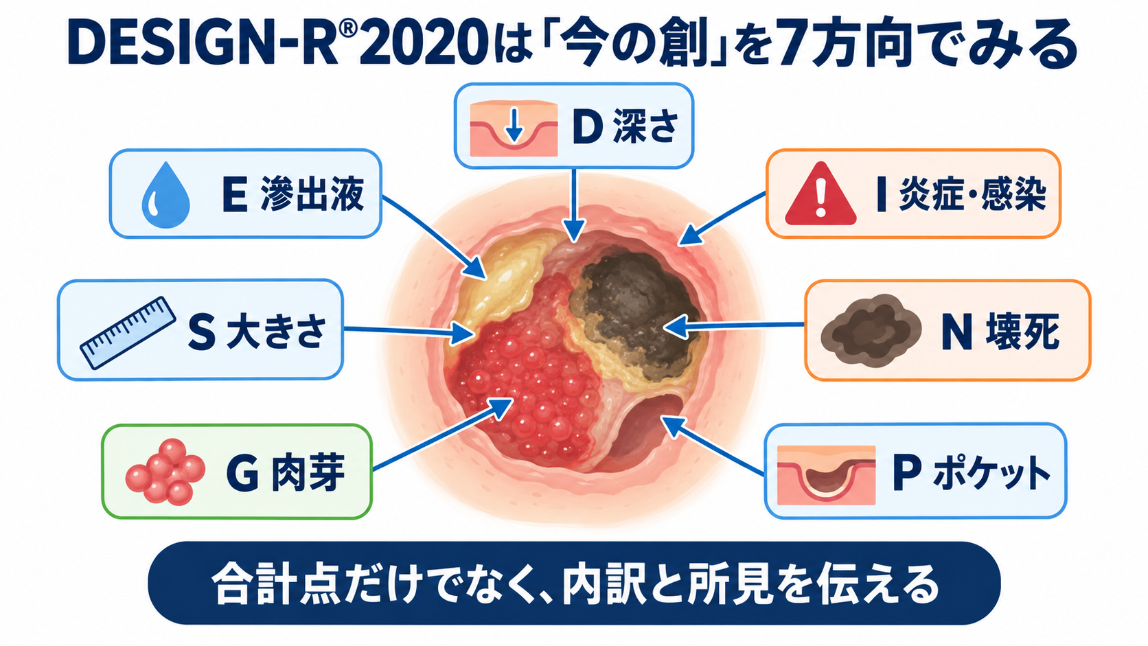 褥瘡の段階はどう伝える？DESIGN-R®2020で皮膚状況を観察・報告する方法：DESIGN-R®2020は「何段階か」より「今どんな創か」を伝える共通言語の図解