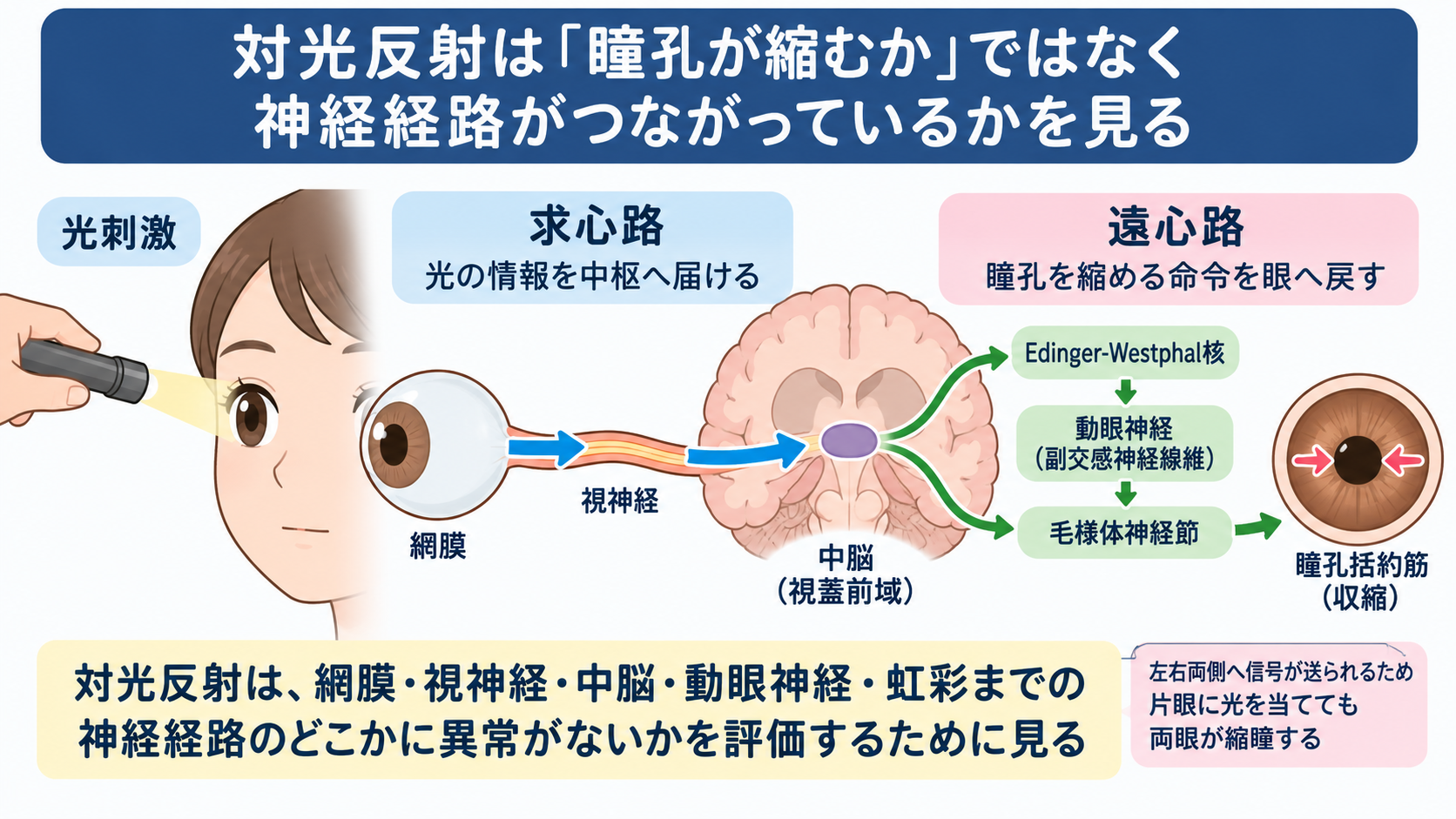 対光反射の見かた｜散瞳・縮瞳・瞳孔不同を症状別に理解する：直接反射と間接反射を比べると「視神経側か動眼神経側か」が見えやすいの図解