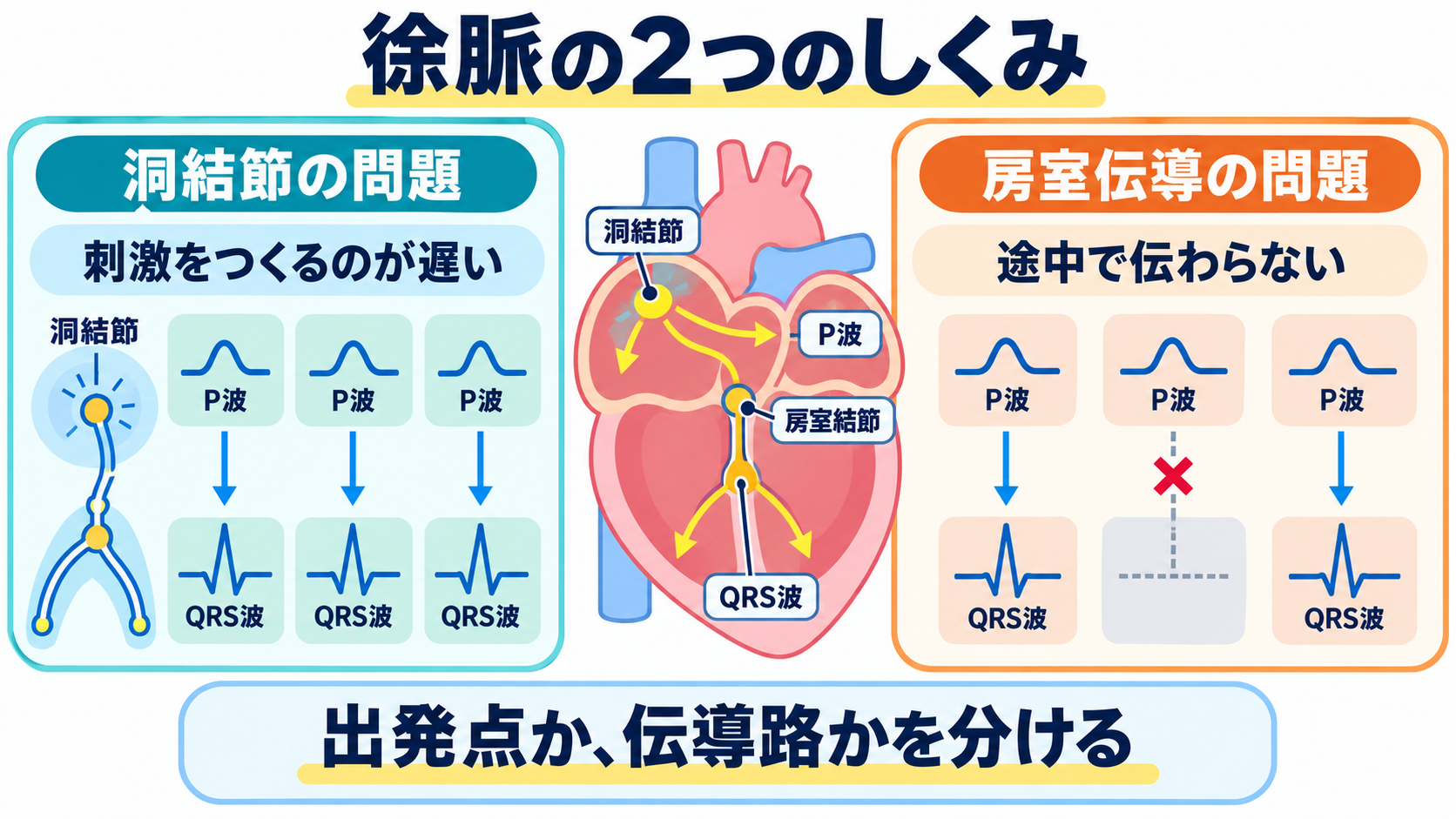 徐脈をどう見分ける？洞徐脈・SSS・徐脈頻脈症候群・房室ブロックの心電図と看護：洞結節でつくる問題と、房室結節より下で伝わらない問題を分けて考えるの図解