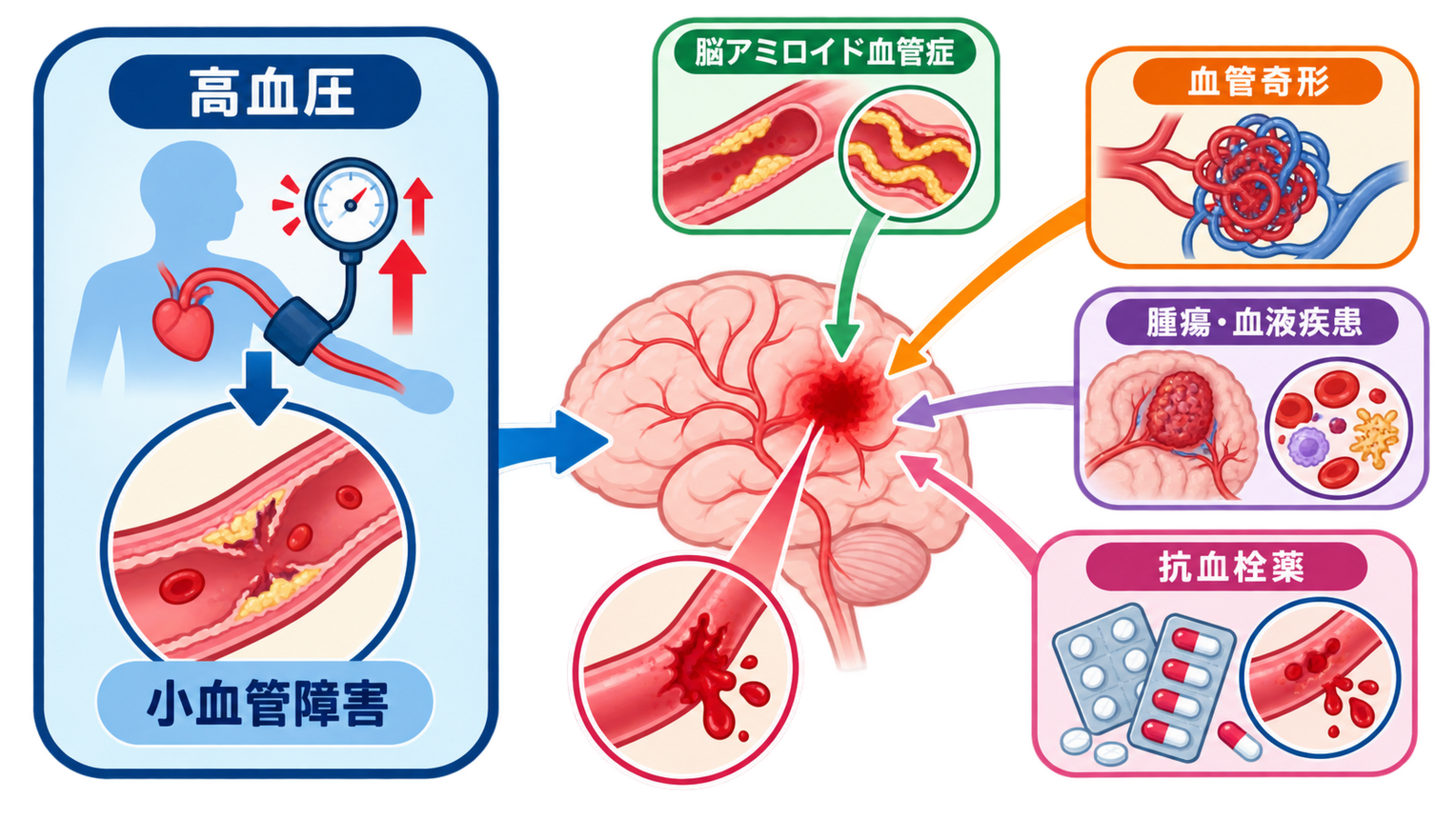 脳出血とは？部位別症状・急性期治療・看護の観察ポイントをわかりやすく解説：脳出血の最大の危険因子は高血圧だが、原因は一つではないの図解