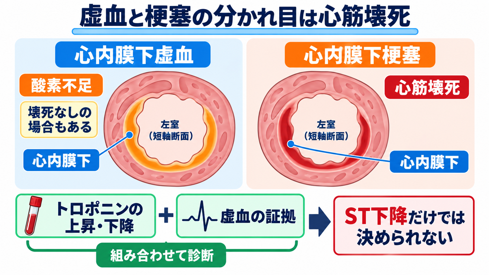 ST下降をどう読む？心筋虚血・心内膜下梗塞と二次性変化、薬剤・電解質異常の見分け方：心内膜下虚血と心内膜下梗塞は同じではなく、壊死の有無が分かれ目になるの図解