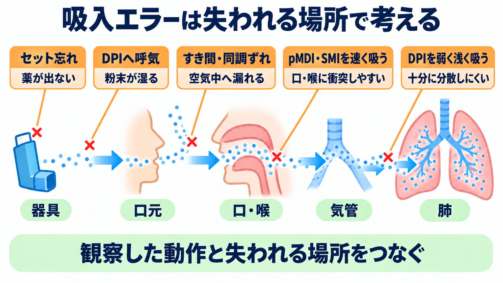 吸入薬の使い方が分かる｜薬の種類・デバイス・うがい・吸入指導の基本：よくある吸入エラーは「どこで薬が失われるか」まで考えるの図解