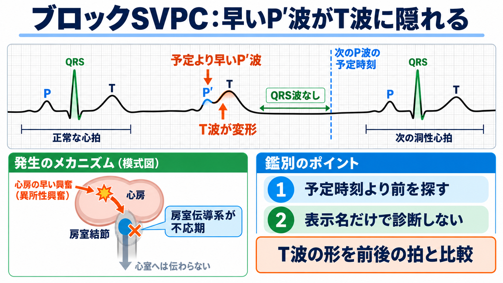 心電図でP波・QRS波が予定位置にないときの見分け方―洞停止、洞房ブロック、房室ブロック、ブロックSVPC：ブロックSVPCでは「予定より早いP波」がT波に隠れ、QRS波だけが抜けたように見えるの図解