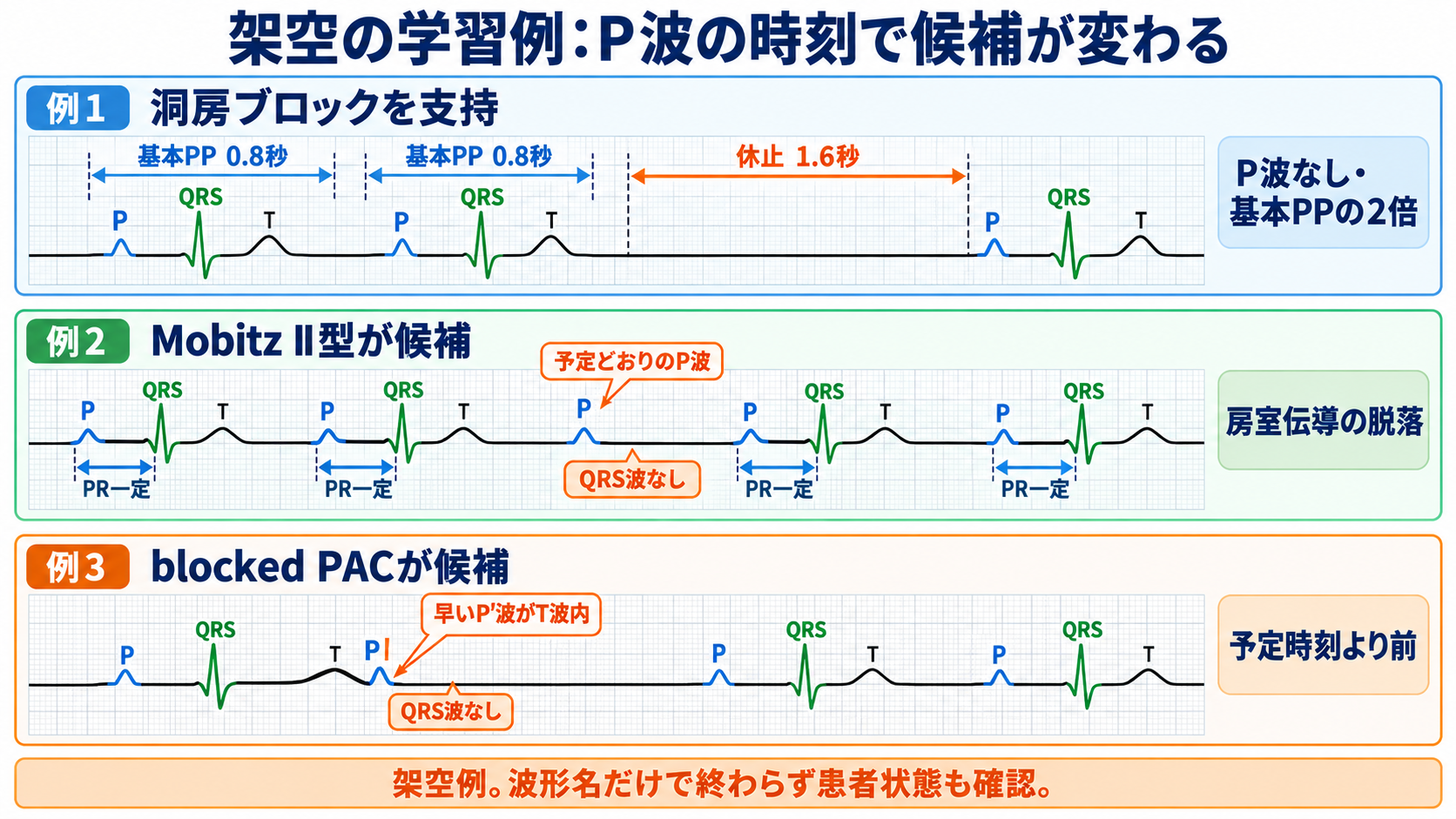 心電図でP波・QRS波が予定位置にないときの見分け方―洞停止、洞房ブロック、房室ブロック、ブロックSVPC：架空の学習例：同じ“1拍抜け”でも、P波の時刻で候補が変わるの図解