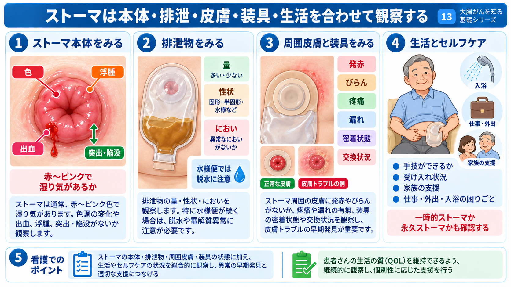大腸がんとは？症状・検査・治療から術後の看護観察まで分かりやすく解説：ストーマは色・浮腫・排泄量・皮膚・装具の適合を合わせて観察するの図解