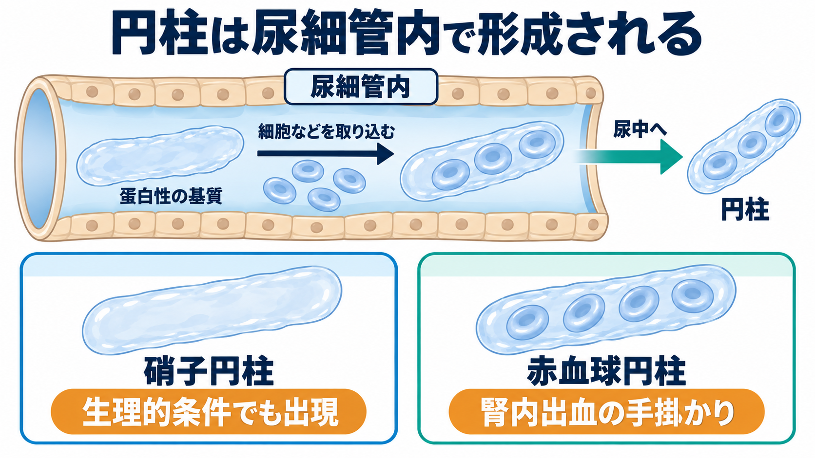尿沈渣の主な成分一覧と、看護に役立つ所見の読み方：円柱は腎内で形成され、内部に含まれる成分で意味が変わるの図解