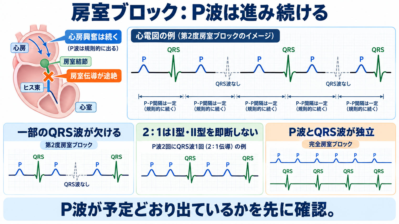 心電図でP波・QRS波が予定位置にないときの見分け方―洞停止、洞房ブロック、房室ブロック、ブロックSVPC：房室ブロックではP波が進み続けても、一部または全部のP波にQRS波が続かないの図解