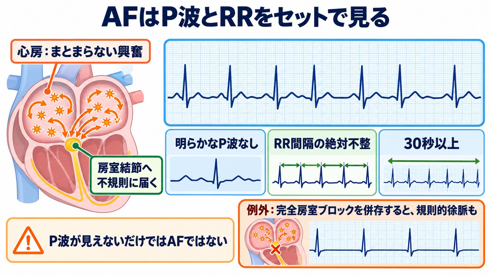 P-QRS関係で見分ける基本調律の異常―心房細動・接合部調律・固有心室調律・心房停止・洞室伝導：心房細動は「P波なし」に加えてRR間隔の絶対不整で捉えるの図解