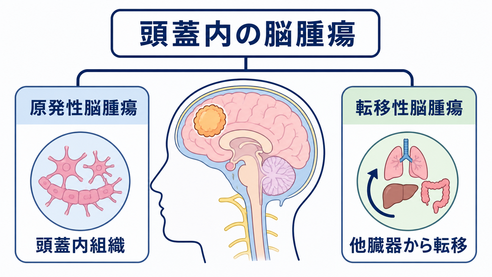 脳腫瘍とは？種類・症状・検査・治療と看護で押さえる観察ポイント：脳腫瘍とは、頭蓋内に発生するさまざまな腫瘍の総称の図解