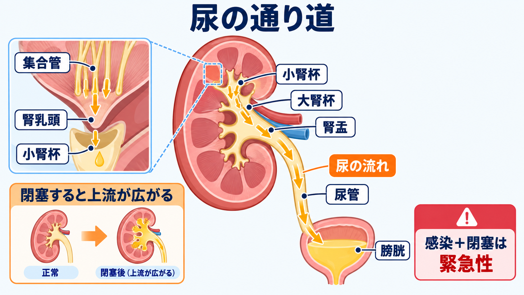 腎臓の解剖を血流と尿の通り道から理解する―ネフロンの構造と看護観察の意味：尿は腎乳頭から腎杯・腎盂・尿管を通って膀胱へ流れるの図解