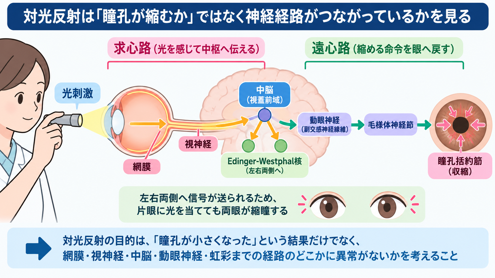 対光反射の見かた｜散瞳・縮瞳・瞳孔不同を症状別に理解する：片側の瞳孔が大きく対光反射が遅鈍・消失しているときは遠心路を考えるの図解