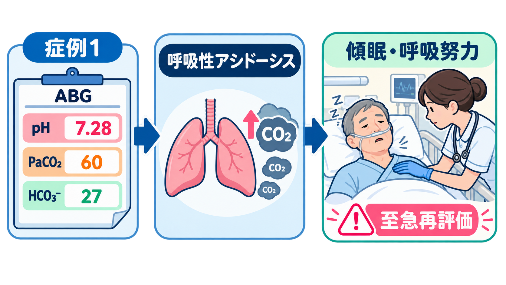 血液ガスの読み方｜pH・換気・酸素化を3ステップで看護判断へつなげる：症例1：PaCO₂上昇と傾眠があれば換気不全を優先するの図解
