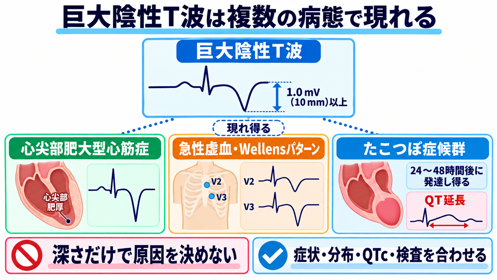 ST下降をどう読む？心筋虚血・心内膜下梗塞と二次性変化、薬剤・電解質異常の見分け方：巨大陰性T波は心尖部肥大型心筋症の代表所見だが、急性虚血やたこつぼ症候群でも現れるの図解