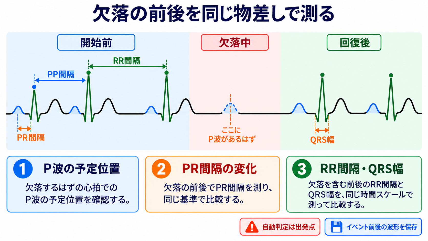心電図でP波・QRS波が予定位置にないときの見分け方―洞停止、洞房ブロック、房室ブロック、ブロックSVPC：波形は1拍だけでなく、欠落の前後を同じ物差しで測るの図解