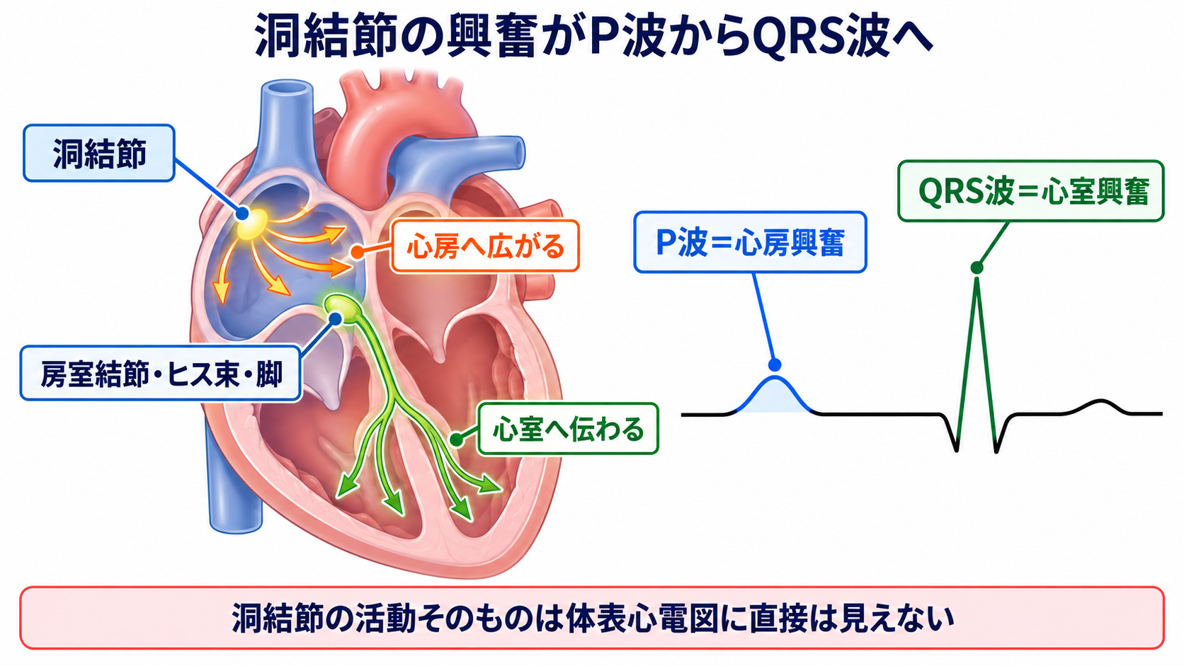 心電図でP波・QRS波が予定位置にないときの見分け方―洞停止、洞房ブロック、房室ブロック、ブロックSVPC：正常では洞結節の興奮がP波になり、その後にQRS波が続くの図解